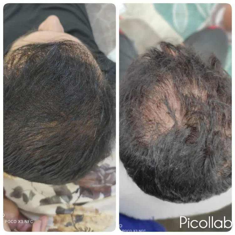 ارسال سریع رایگان برای جلوگیری از ریزش مو بسته بندی شیک