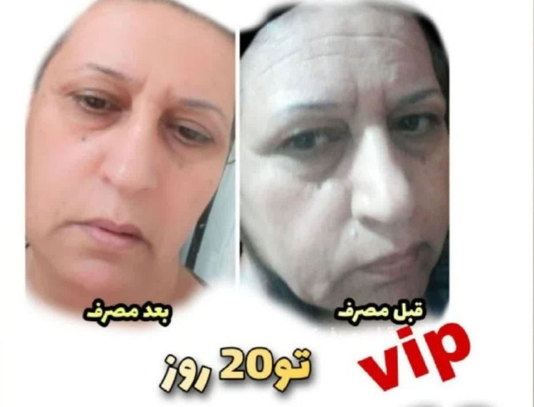 کرم لیفت vip در۲۰ روز اورجینال باتضمین
