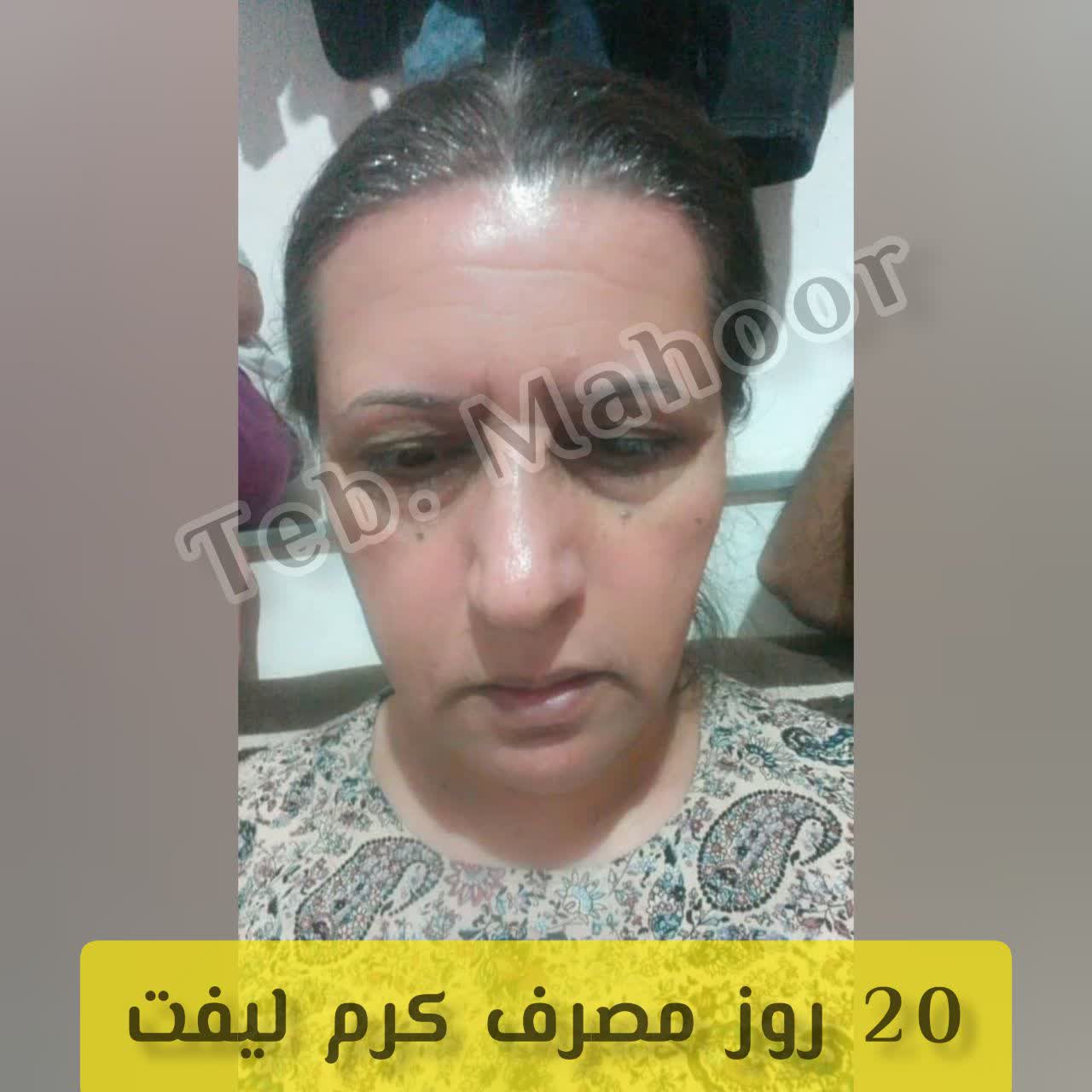 نتیجه سریع کرم لیفت صورت باضمانت