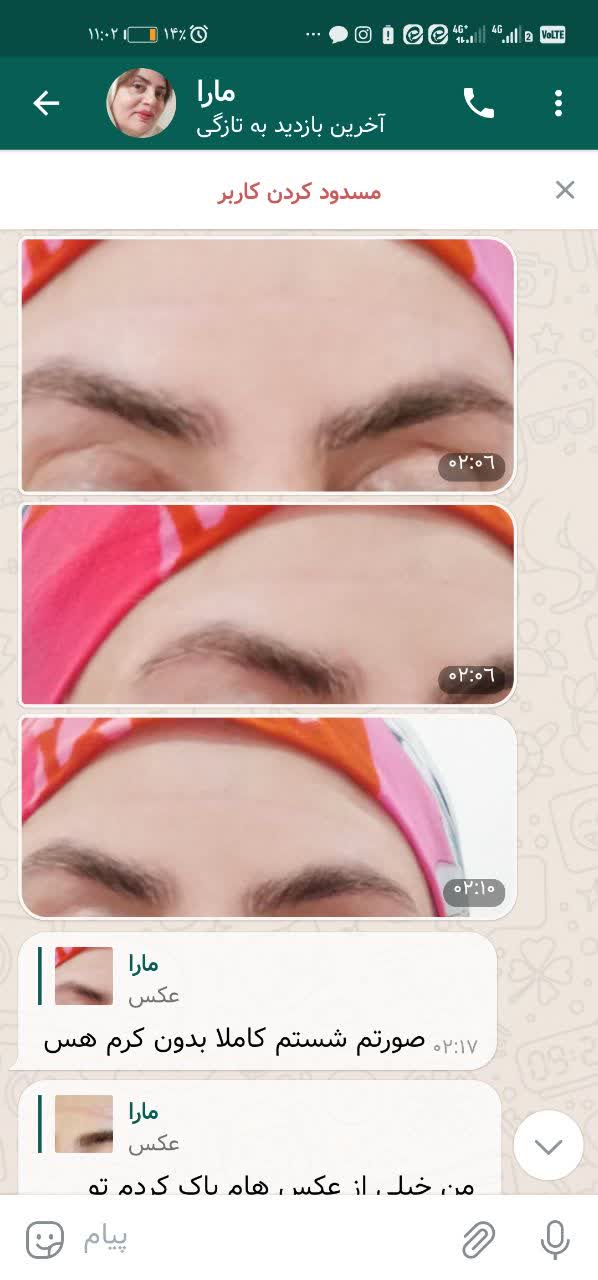 خلاصی از جای ذخم بخیه  خرید آنلاین. ارسال رایگان به موقع